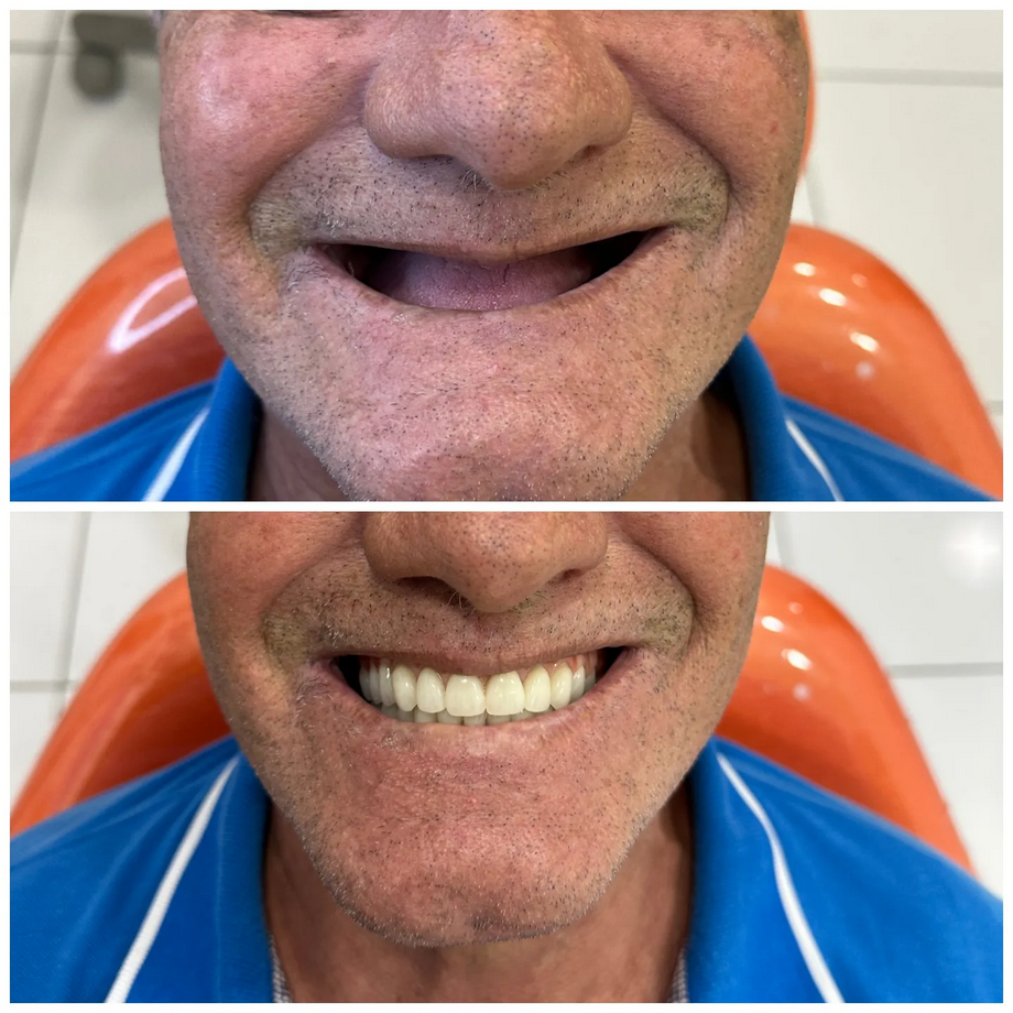 Implante dentário — antes e depois
