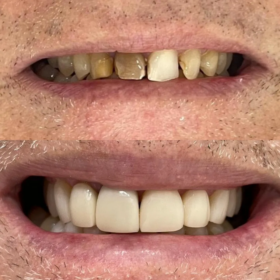 Antes e depois — restauração dentária